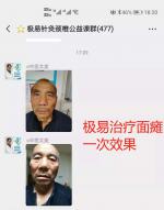 极易针灸治疗面瘫